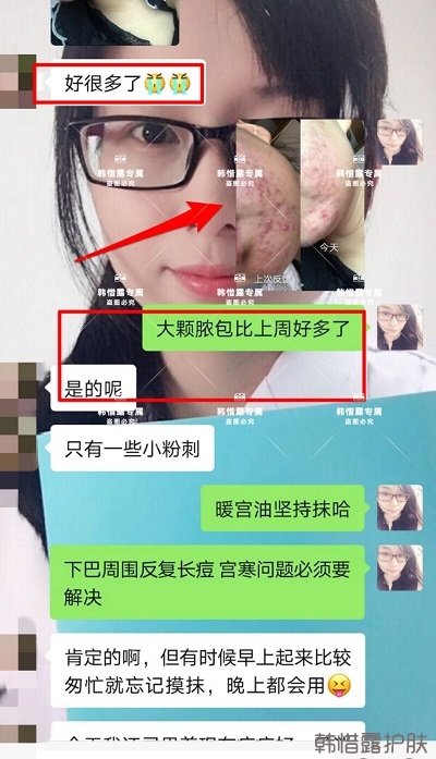 臉上長(zhǎng)痘如何消除，下巴長(zhǎng)痘案例反饋，膿包痘痘好多了