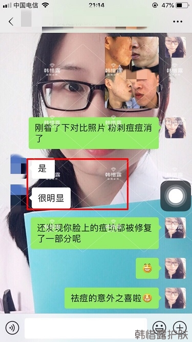 敏感肌粉刺痘痘全部消下去了，痘坑也修復(fù)平整了一部分