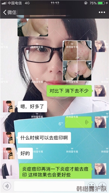 痘痘好多了，認真聽話按照要求使用，每個人都可以變很美！