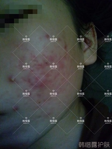 祛痘后判若兩人，膿包痘消了變小仙女