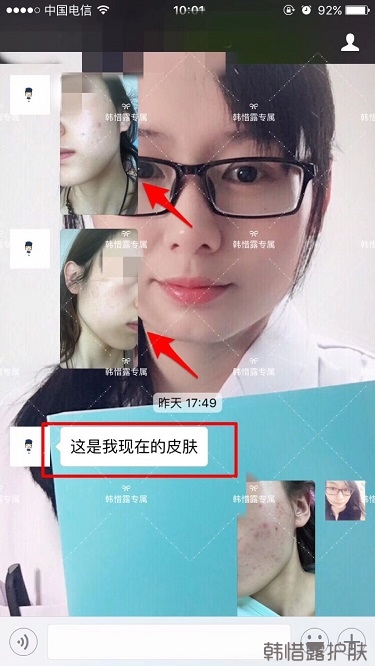 痘痘好了皮膚美麗，不想再記起曾經(jīng)滿臉痘痘的自己！