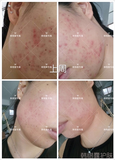 痘痘好多了，認真聽話按照要求使用，每個人都可以變很美！
