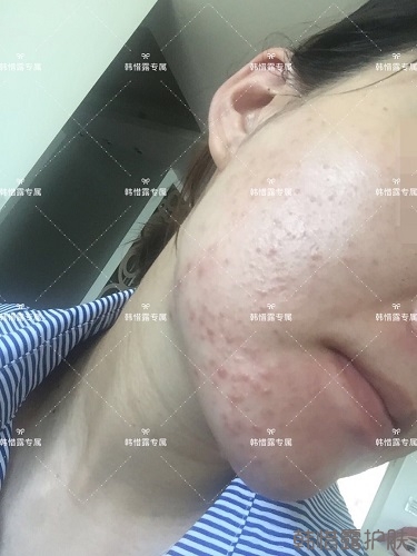 粉刺痘痘，痘印都沒(méi)了，寶媽重回顏值巔峰！