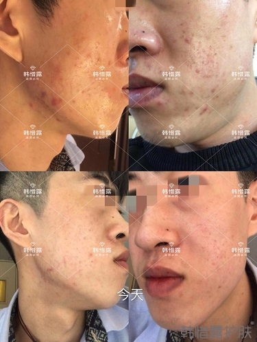敏感肌粉刺痘痘全部消下去了，痘坑也修復(fù)平整了一部分