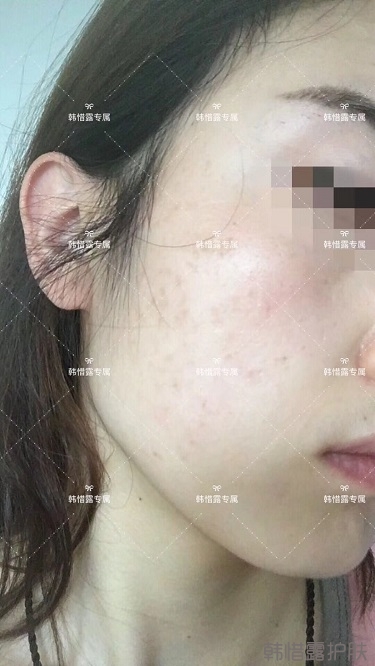 痘痘好了皮膚美麗，不想再記起曾經(jīng)滿臉痘痘的自己！