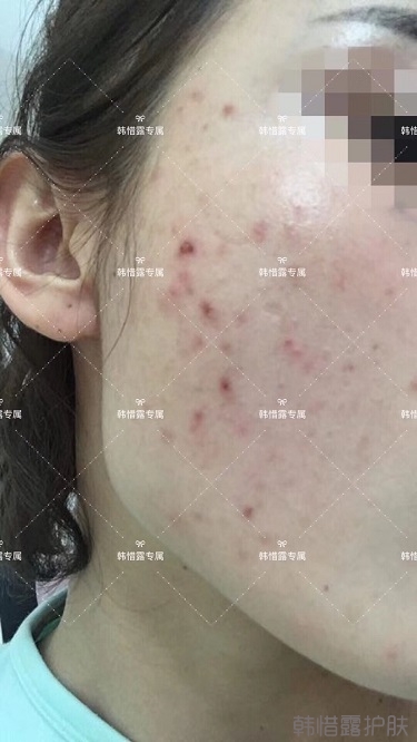 痘痘好了皮膚美麗，不想再記起曾經(jīng)滿臉痘痘的自己！