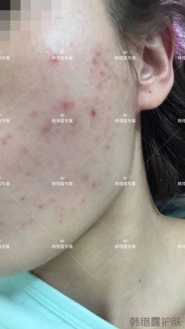痘痘好了皮膚美麗，不想再記起曾經(jīng)滿臉痘痘的自己！