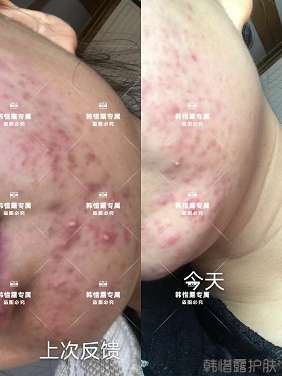臉上長(zhǎng)痘如何消除，下巴長(zhǎng)痘案例反饋，膿包痘痘好多了