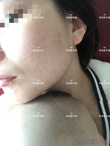 粉刺痘痘，痘印都沒(méi)了，寶媽重回顏值巔峰！