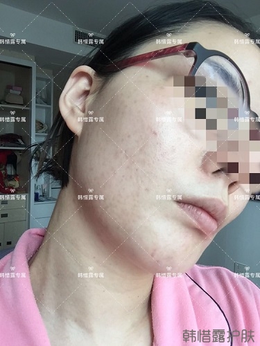 粉刺痘痘，痘印都沒(méi)了，寶媽重回顏值巔峰！