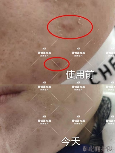 怎么消除臉上的痘痘，發硬膿包消下去了