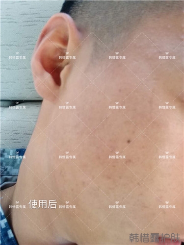 粉刺消了，皮膚光滑了，變帥氣不少呦！