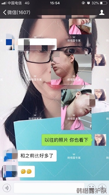 粉刺痘痘，痘印都沒(méi)了，寶媽重回顏值巔峰！