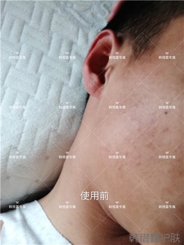 粉刺消了，皮膚光滑了，變帥氣不少呦！