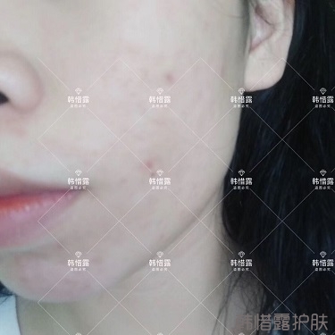 祛痘后判若兩人，膿包痘消了變小仙女