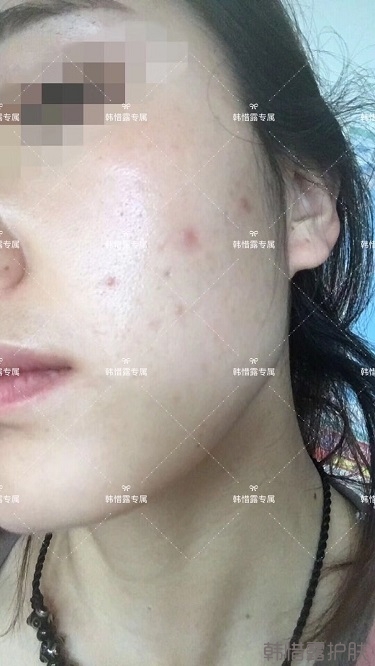 痘痘好了皮膚美麗，不想再記起曾經(jīng)滿臉痘痘的自己！