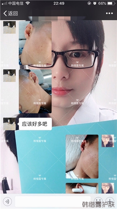 粉刺消了，皮膚光滑了，變帥氣不少呦！