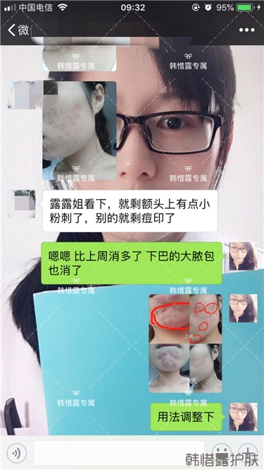 粉刺只剩一點點了，敏感肌粉刺修復，更美麗！