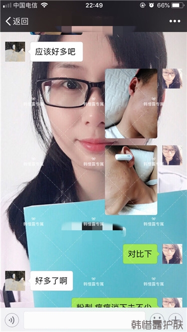 粉刺消了，皮膚光滑了，變帥氣不少呦！