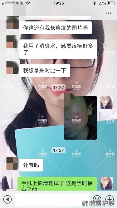 祛痘后判若兩人，膿包痘消了變小仙女