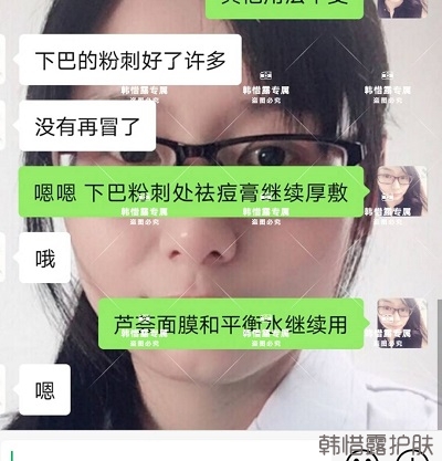 閉口粉刺怎么去除，下巴粉刺好了許多，粉刺沒有再長了