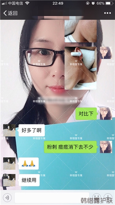 粉刺消了，皮膚光滑了，變帥氣不少呦！