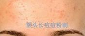 額頭長(zhǎng)痘，臉頰長(zhǎng)痘痘粉刺，就這樣恢復(fù)嫩白肌膚！