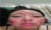 【祛痘視頻反饋】激素臉長(zhǎng)痘20多年，大膿包，發(fā)癢，完全恢復(fù)！