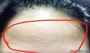 怎么才能去掉閉口痘痘呢？