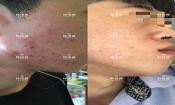 敏感肌粉刺痘痘全部消下去了，痘坑也修復平整了很多