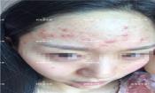臉上長(zhǎng)粉刺怎樣去掉？醫(yī)院都沒搞定韓惜露幫我搞定了，超級(jí)開心！【視頻】