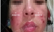 激素臉怎么修復？皮膚完全恢復，視頻反饋！